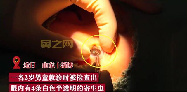 2岁男童眼睛现4条寄生虫游动