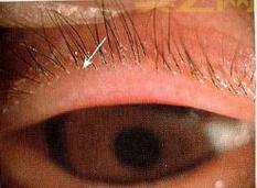 2岁男童眼睛现4条寄生虫游动