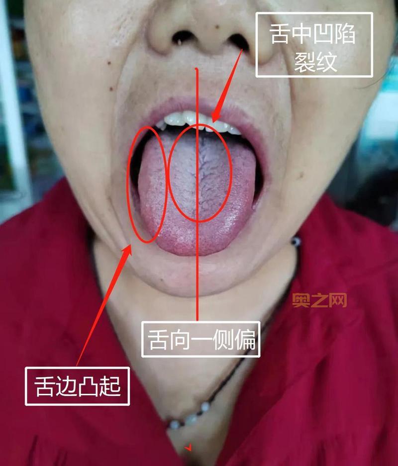 舌头流水不止？警惕可能的健康问题