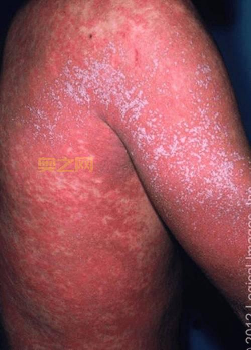 红热病(猩红热)传染性强,预防与隔离措施全解析