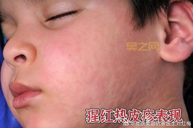红热病（猩红热）传染性强，预防与隔离措施全解析