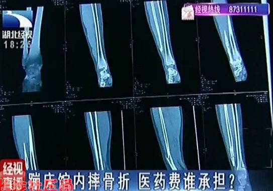 8岁女童玩蹦床坠落 昏迷 重症病房 呼吸机 维持生命体征_儿童充气蹦蹦床厂家_福建泉州女童蹦床事故 医生提醒 幼童不宜玩剧烈游戏 安全隐患