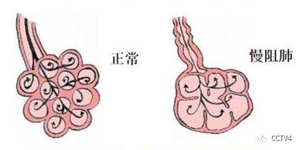 慢阻肺预防_慢阻肺症状_慢性支气管炎与慢阻肺